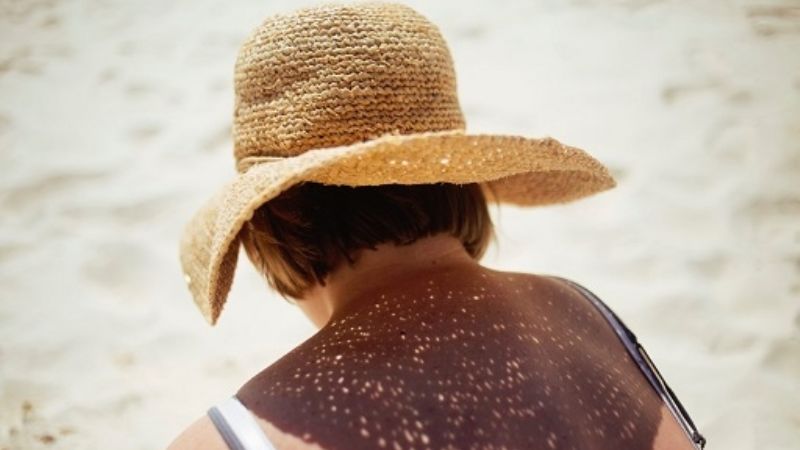 Cáncer de piel: Medidas de prevención