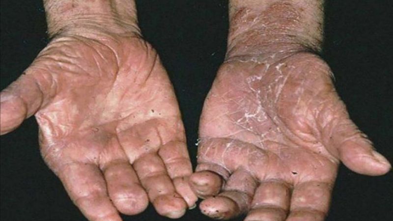 La OMS alertó por el avance de la lepra en medio de la pandemia