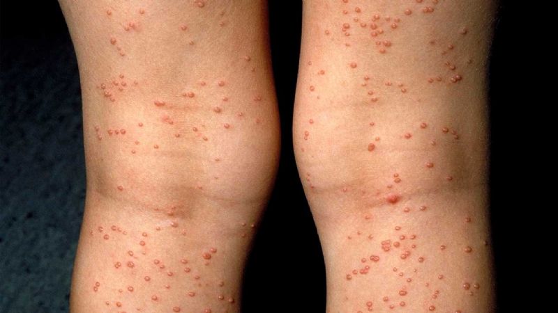 La UNCA difunde serie informativa sobre el HIV/Sida