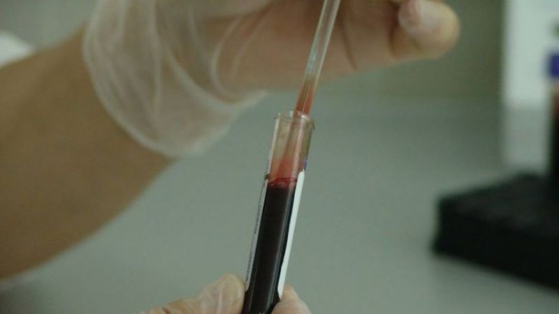 Descubren variante del VIH más virulenta y contagiosa