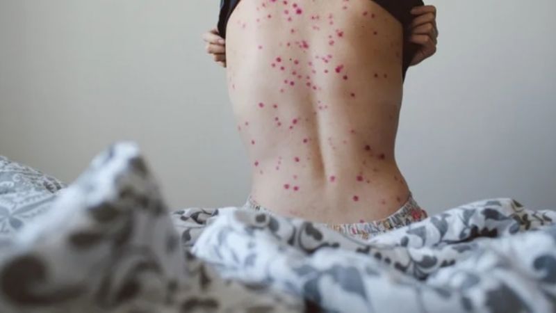 Viruela de mono: la OMS llamó a una reunión de emergencia