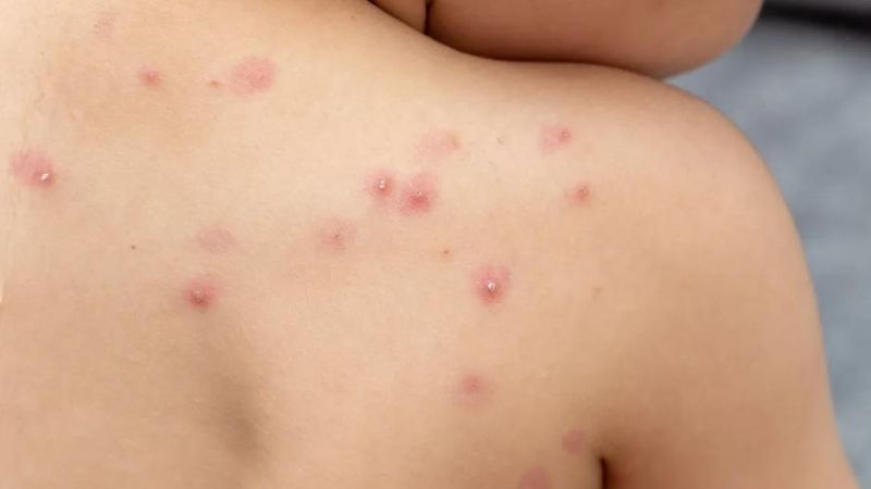 Los argentinos que nacieron en los años 70 deben saber esto sobre la viruela del mono