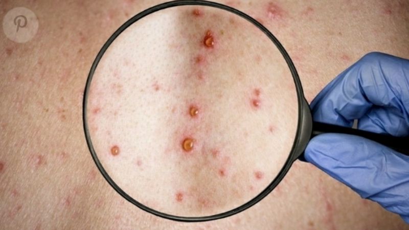 Salud evalúa un segundo caso sospechoso tras confirmar primer contagio en Argentina