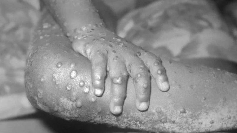 El Ministerio de Salud confirmó el segundo caso de viruela del mono