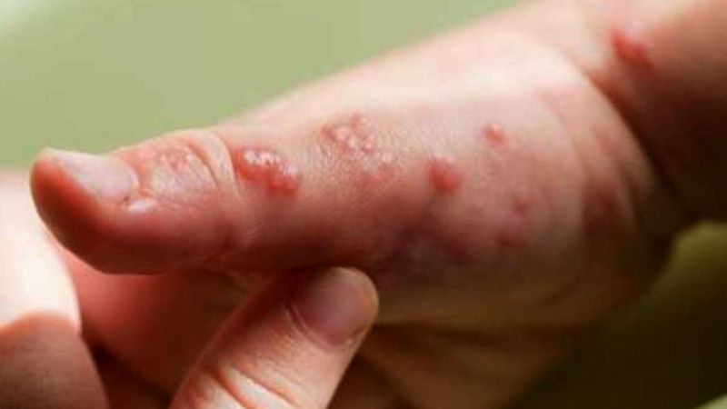 OMS decide que aún no se trata de una emergencia sanitaria internacional