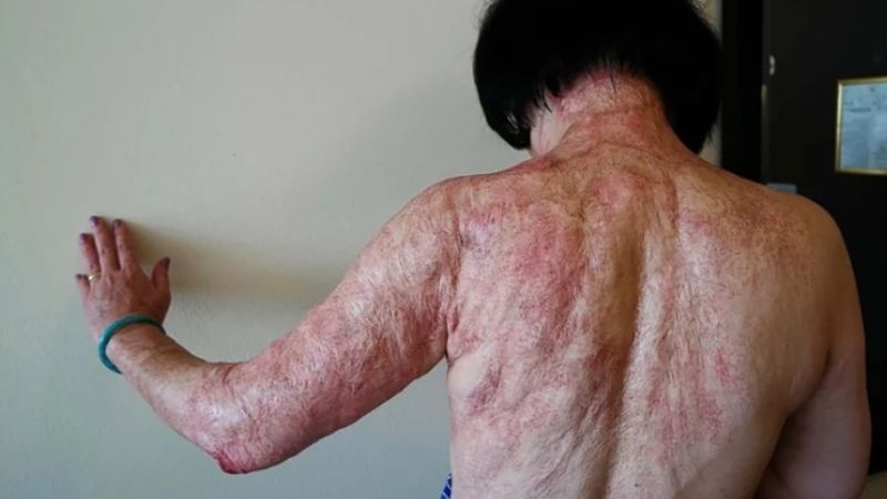 La “niña del napalm” de Vietnam culminó 50 años después un tratamiento para sanar su piel