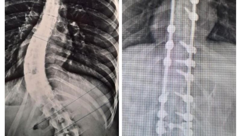 Nueva intervención de columna vertebral