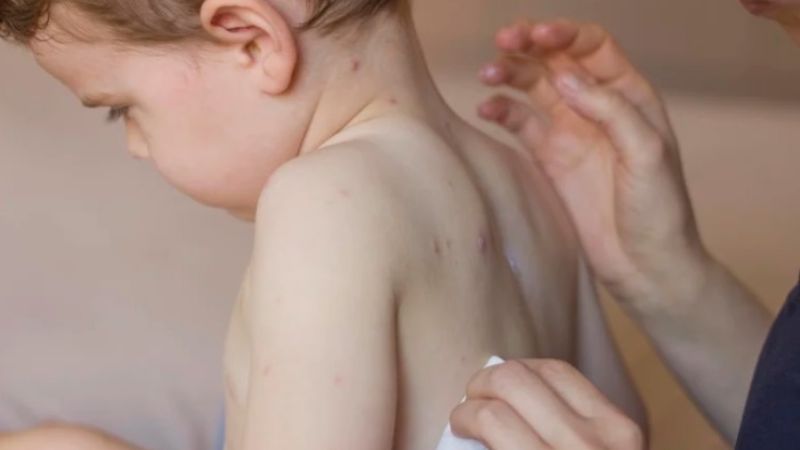 El Ministerio de Salud confirmó un caso de sarampión en la Argentina