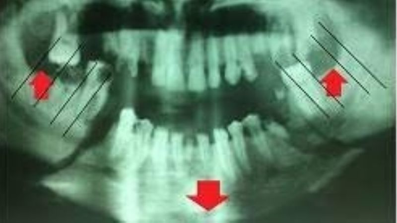 Fue condenado a 4 años de prisión por quebrarle la mandíbula a una mujer