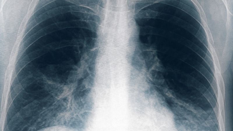 Ocho nuevos casos de neumonía bilateral en Tucumán