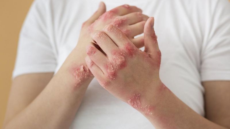 La ANMAT aprobó un nuevo medicamento para la psoriasis moderada a severa