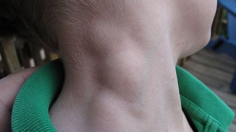 El 82% de los pacientes con linfoma sufren efectos psicológicos por su enfermedad