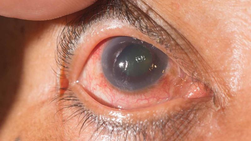 Salud: control gratuito de Glaucoma