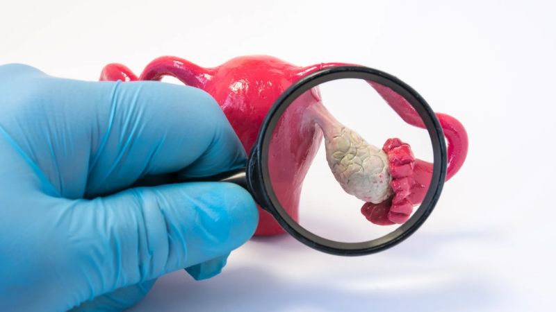 Cáncer de Ovario: la sexta causa de mortalidad por cáncer en mujeres