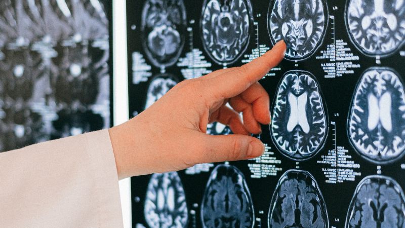 Cuidados del cerebro y prevención del ACV