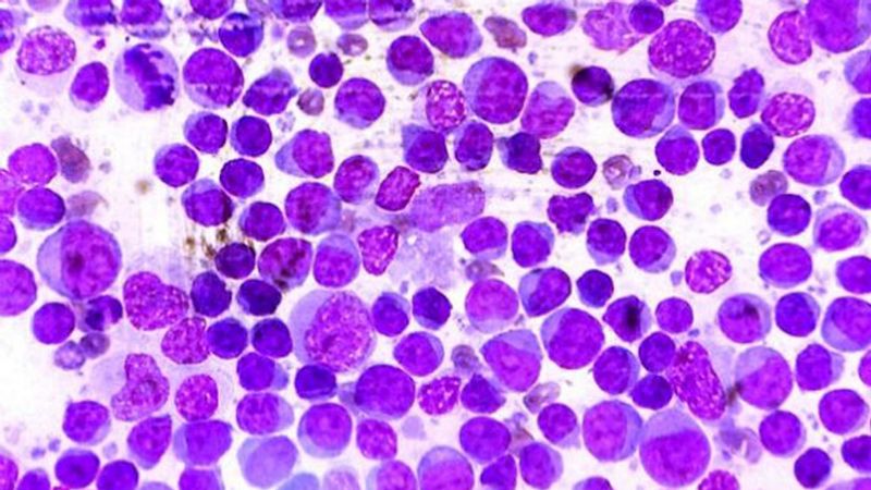 Linfomas: la importancia de conocer algunos síntomas para una detección temprana