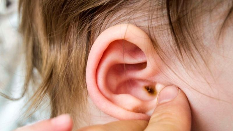 Recomendaciones para prevenir o tratar la famosa otitis externa