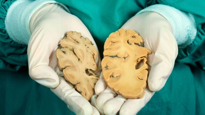 Alzheimer: cómo combatir la enfermedad que afecta a millones de personas