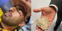 ASI QUEDÓ el rostro de Olivera (izquierda) luego del impacto de la piedra arrojada desde la tribuna de Rosario Central (derecha).