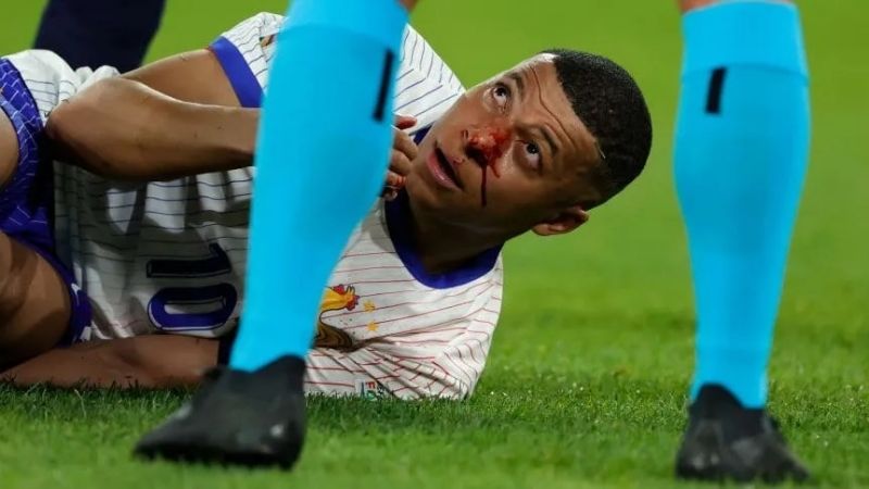 Mbappé se fracturó la nariz, pero no será operado