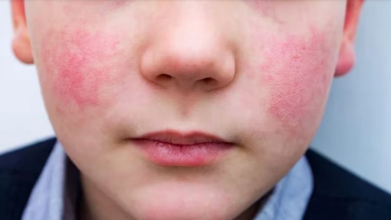 Qué es la “quinta enfermedad” y por qué están creciendo los casos en el mundo