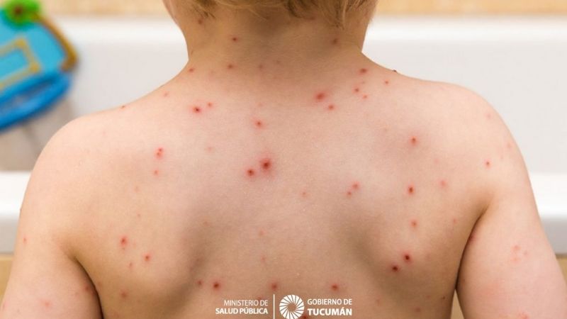 Preocupación por casos de varicela en Tinogasta