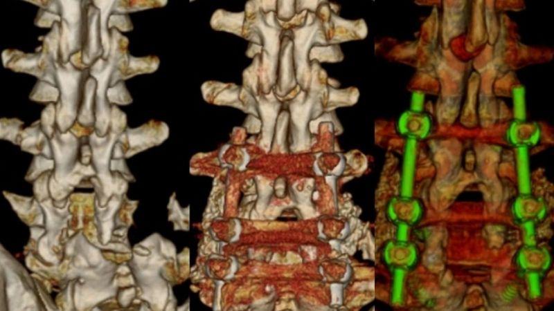 Exitosa cirugía de columna