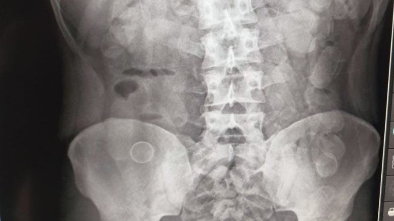 Detuvieron a dos hombres que ingirieron 184 cápsulas de cocaína