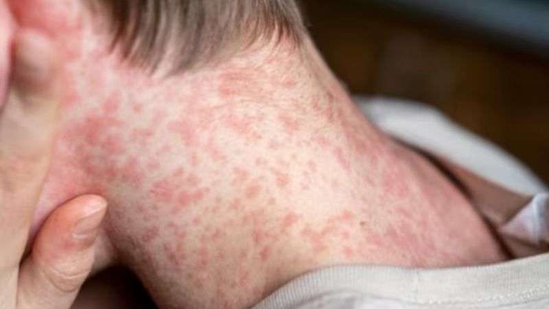 La familia que cruzó medio país con sarampión tuvo al menos 98 contactos estrechos