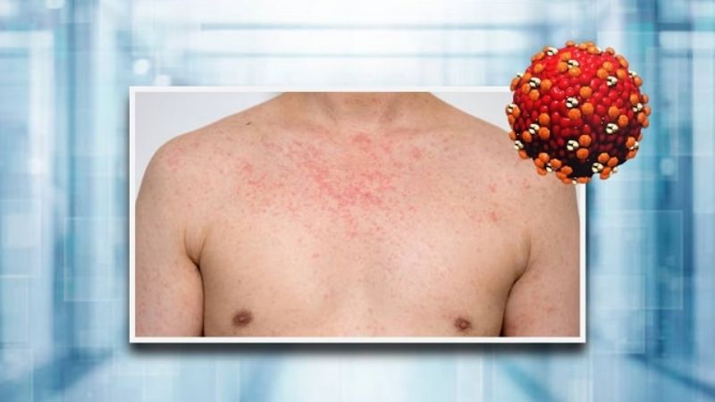 Advierten sobre un fuerte aumento de casos de sarampión, paperas y hepatitis A