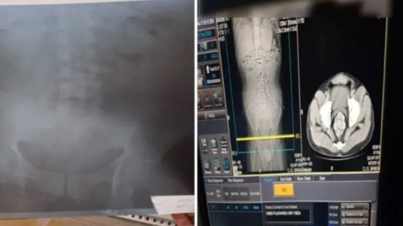 Adolescente boliviano en grave estado tras ingerir 54 cápsula con droga