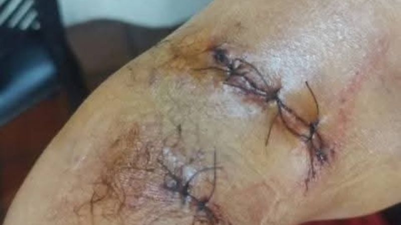 Un profesional fue gravemente atacado por un perro en El Rodeo