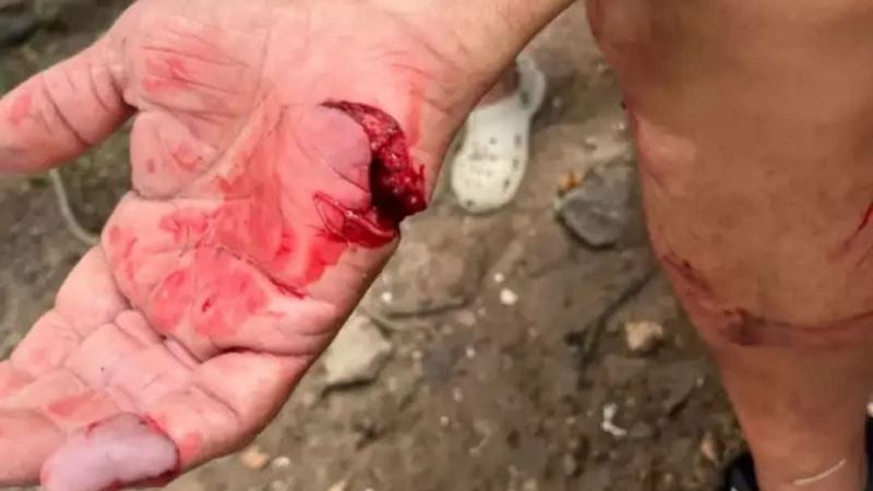 Brutal ataque de un pitbull a un hombre en la Capital