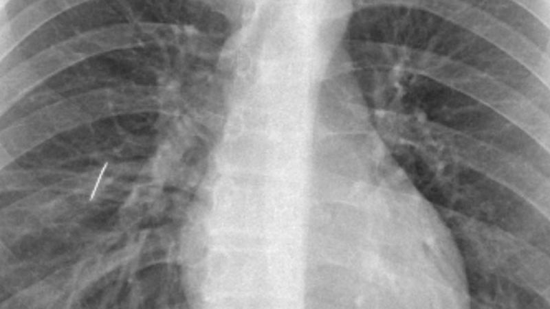 Extraen una aguja de coser del pulmón de un joven