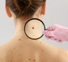 OSEP realizará una serie de actividades por el Día Mundial del Cáncer de Piel
