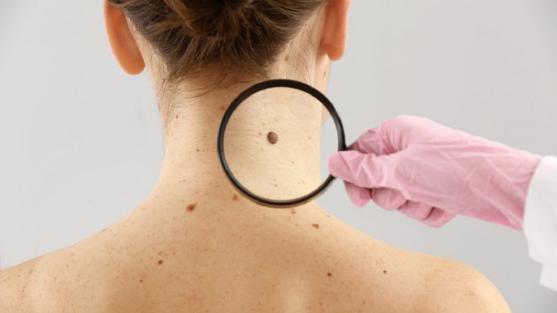 OSEP realizará una serie de actividades por el Día Mundial del Cáncer de Piel
