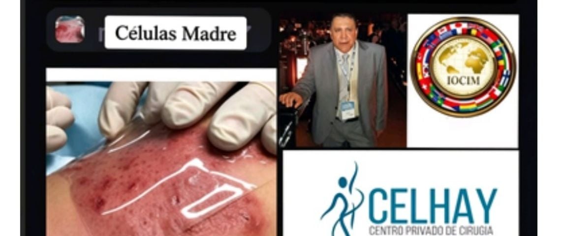 Medicina regenerativa: destacan investigación argentina pionera para tratar quemaduras con tejidos placentarios y de cordón umbilical
