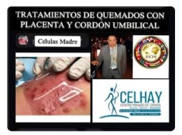 Medicina regenerativa: destacan investigación argentina pionera para tratar quemaduras con tejidos placentarios y de cordón umbilical