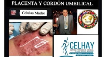 Medicina regenerativa: destacan investigación argentina pionera para tratar quemaduras con tejidos placentarios y de cordón umbilical