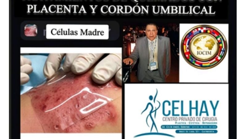 Medicina regenerativa: destacan investigación argentina pionera para tratar quemaduras con tejidos placentarios y de cordón umbilical